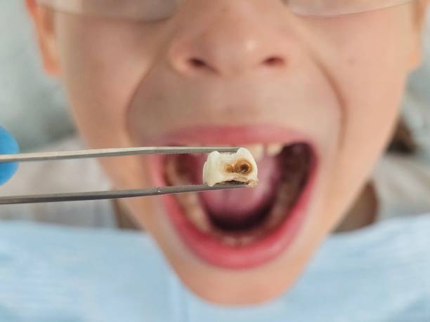 Best Emergency Dentist for Lost Fillings or Crowns in Owensville, IN