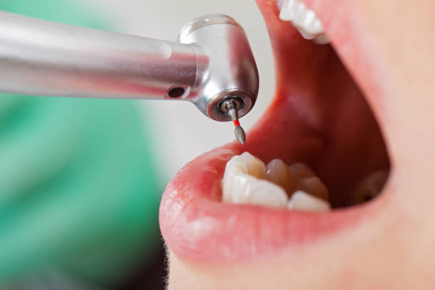 Best Broken or Cracked Tooth Emergency Dentist in Owensville, IN